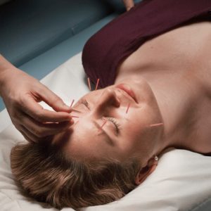 Cosmetic Facial Acupuncture